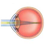 Hyperopia