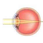 Hyperopia