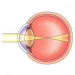 Myopia