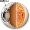 cataract