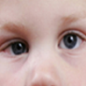 squint in children